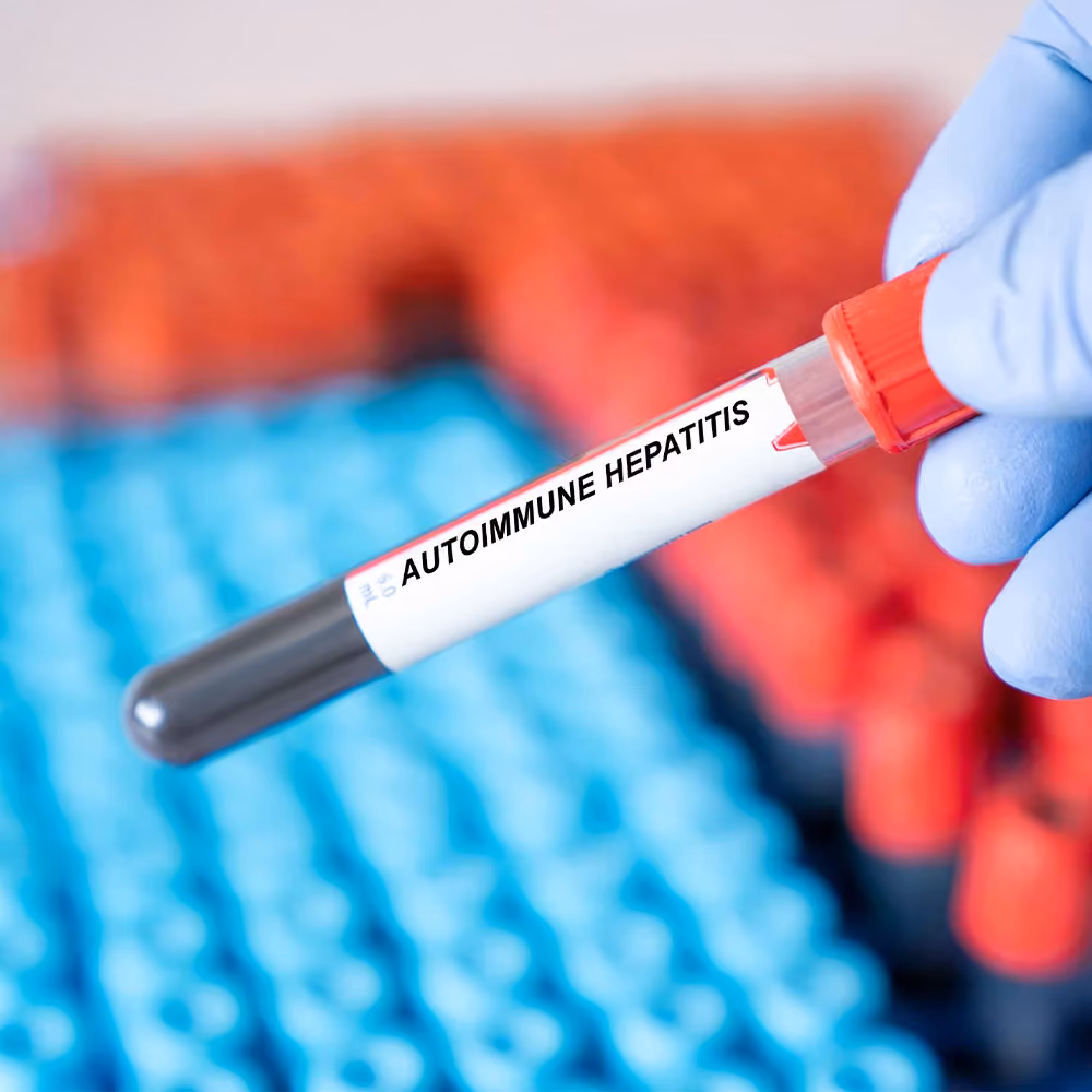Blood sample labelled for autoimmune hepatitis testing, illustrating laboratory diagnosis of autoimmune liver disease.