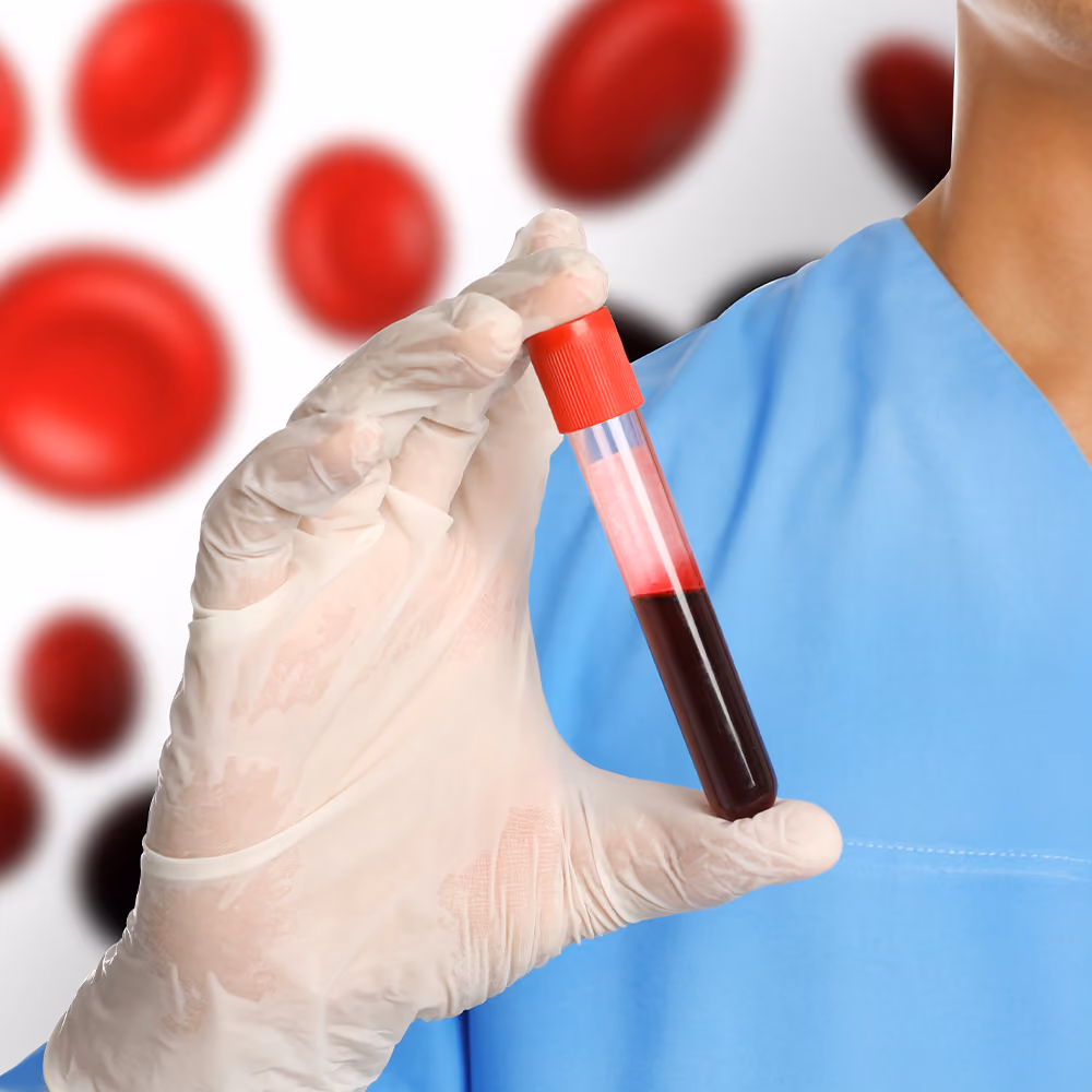 Healthcare professional holding a blood sample used to diagnose and monitor anaemia in a clinical laboratory setting.