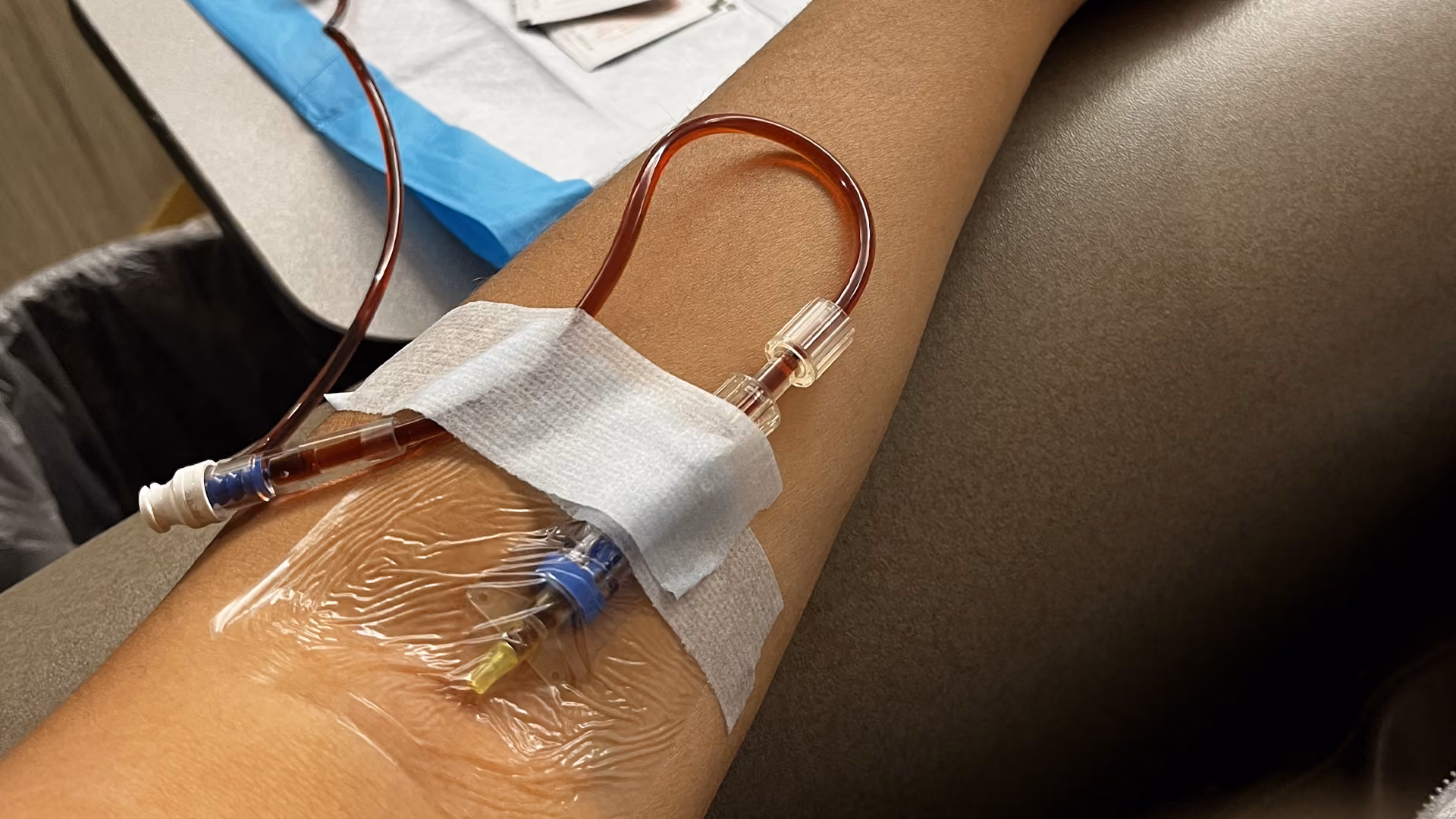 Close-up of an intravenous cannula secured to a patient's arm during an iron infusion, with iron solution flowing through the IV tubing.