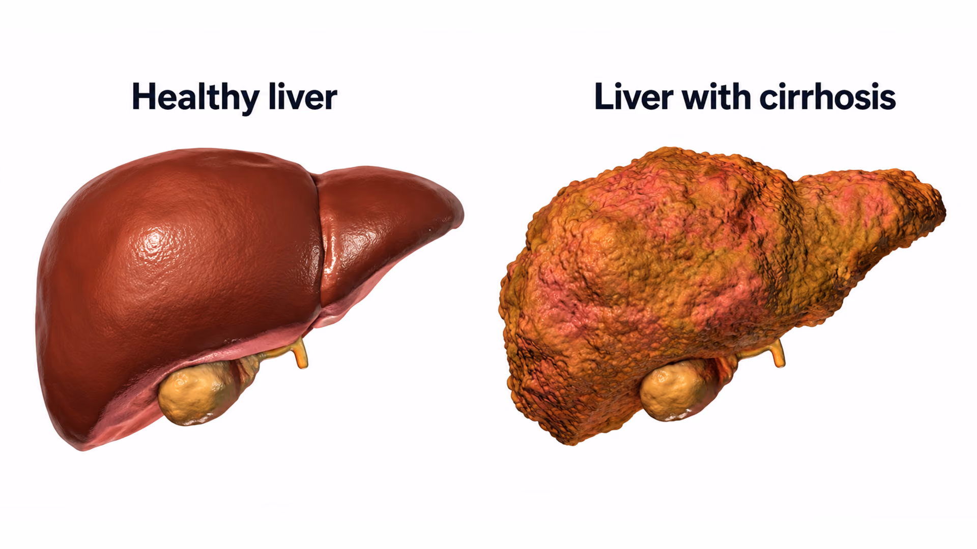 An illustration comparing a smooth, reddish healthy liver with a bumpy, discoloured brown liver with cirrhosis.