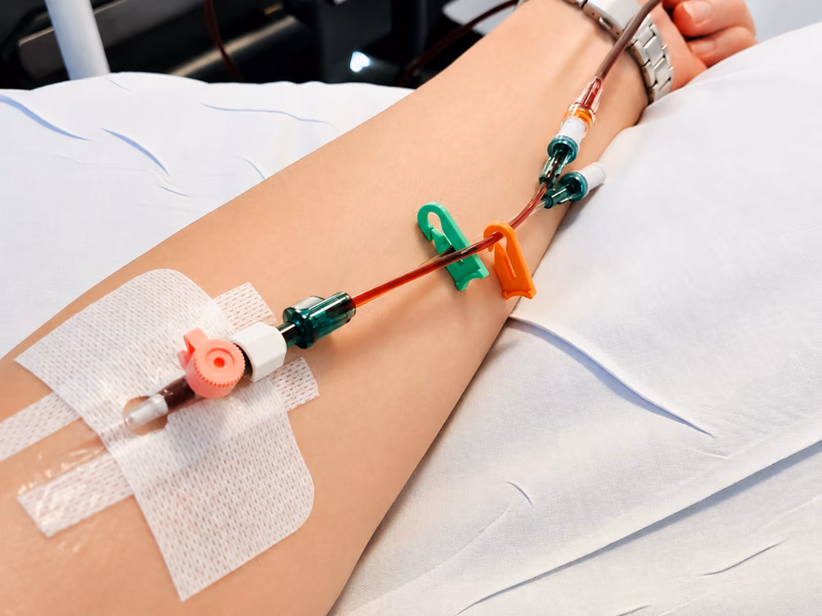 Close-up of a patient's forearm with an intravenous cannula secured in place and blood-filled tubing connected during an iron infusion treatment.