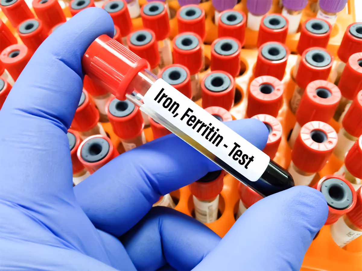 Close-up of a blood sample labelled "Iron Ferritin Test," representing blood testing to assess iron deficiency and ferritin levels.
