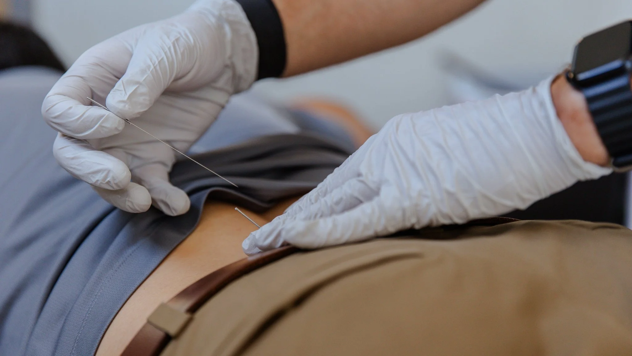 Low Back Pain Dry Needling Greenville SC