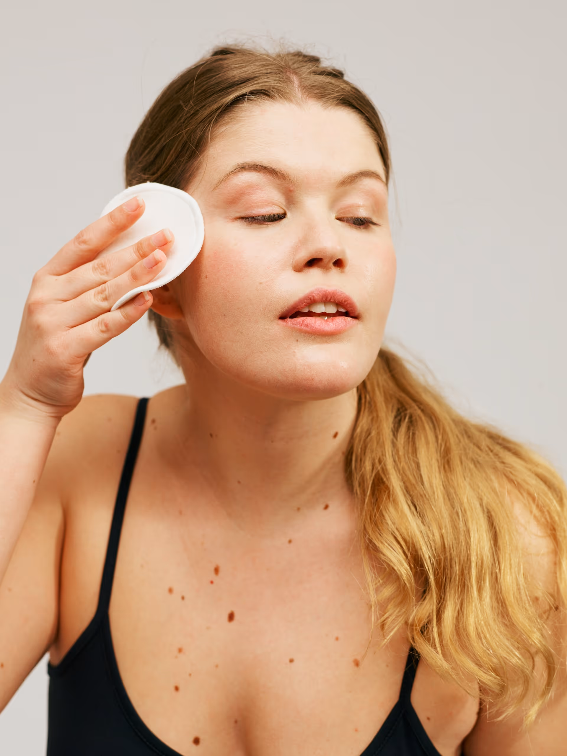 Before treatment - rosacea