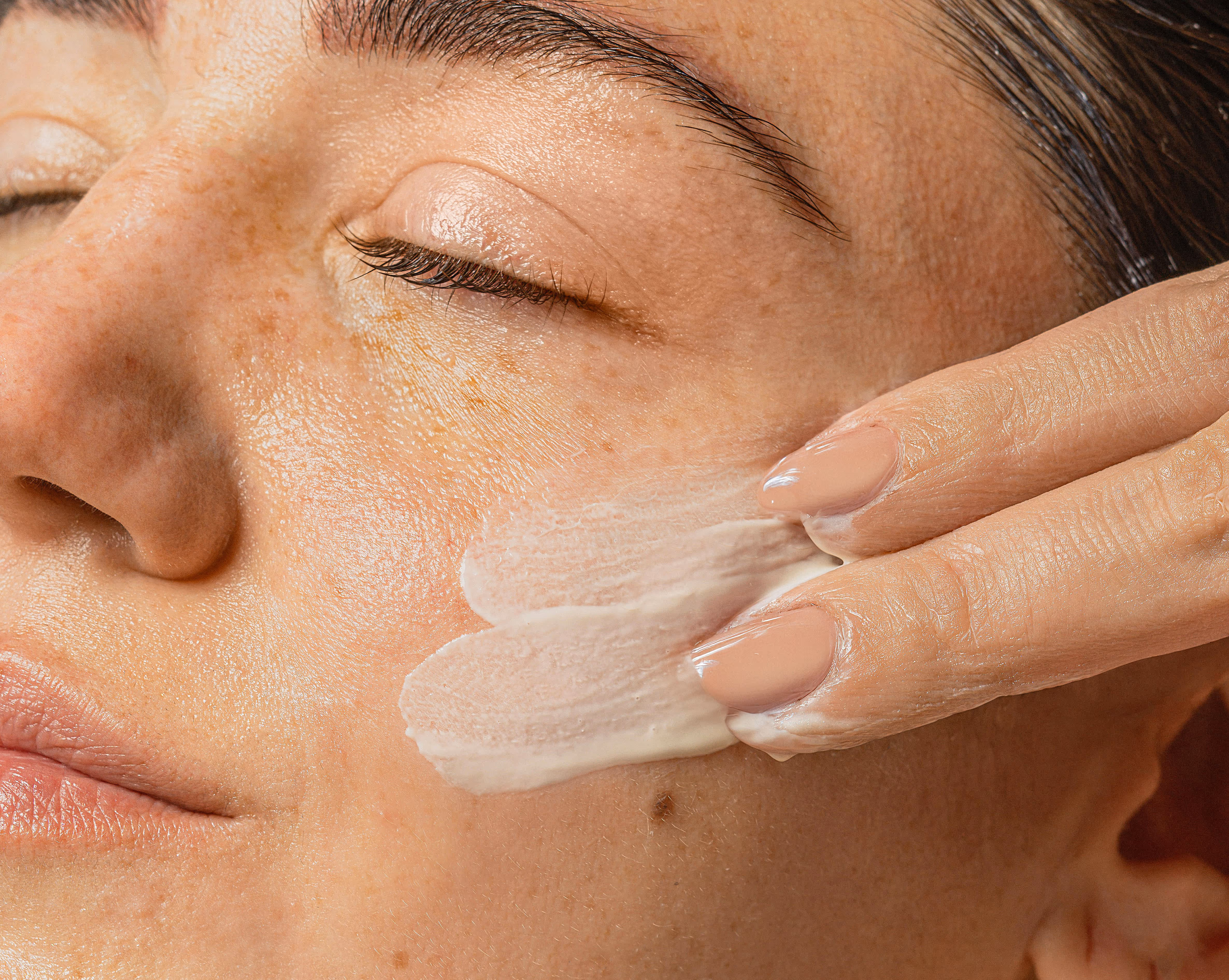 Before treatment - dark spots