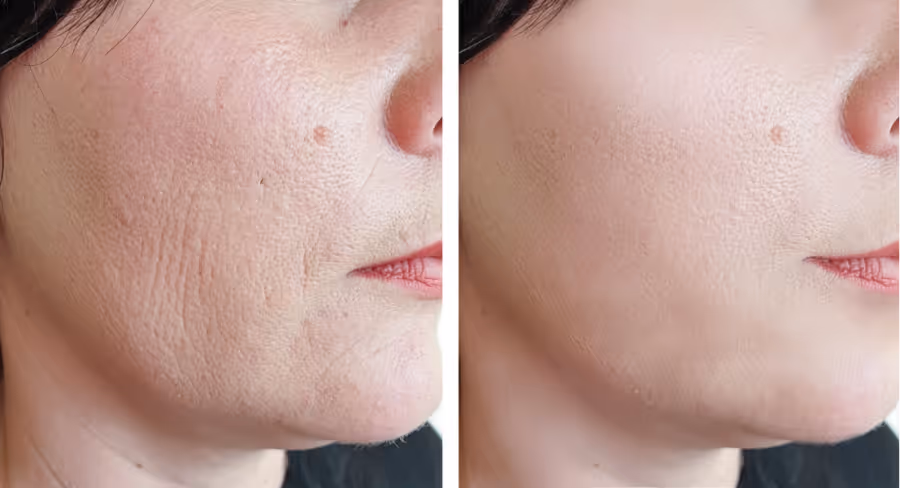 Anti-Aging results