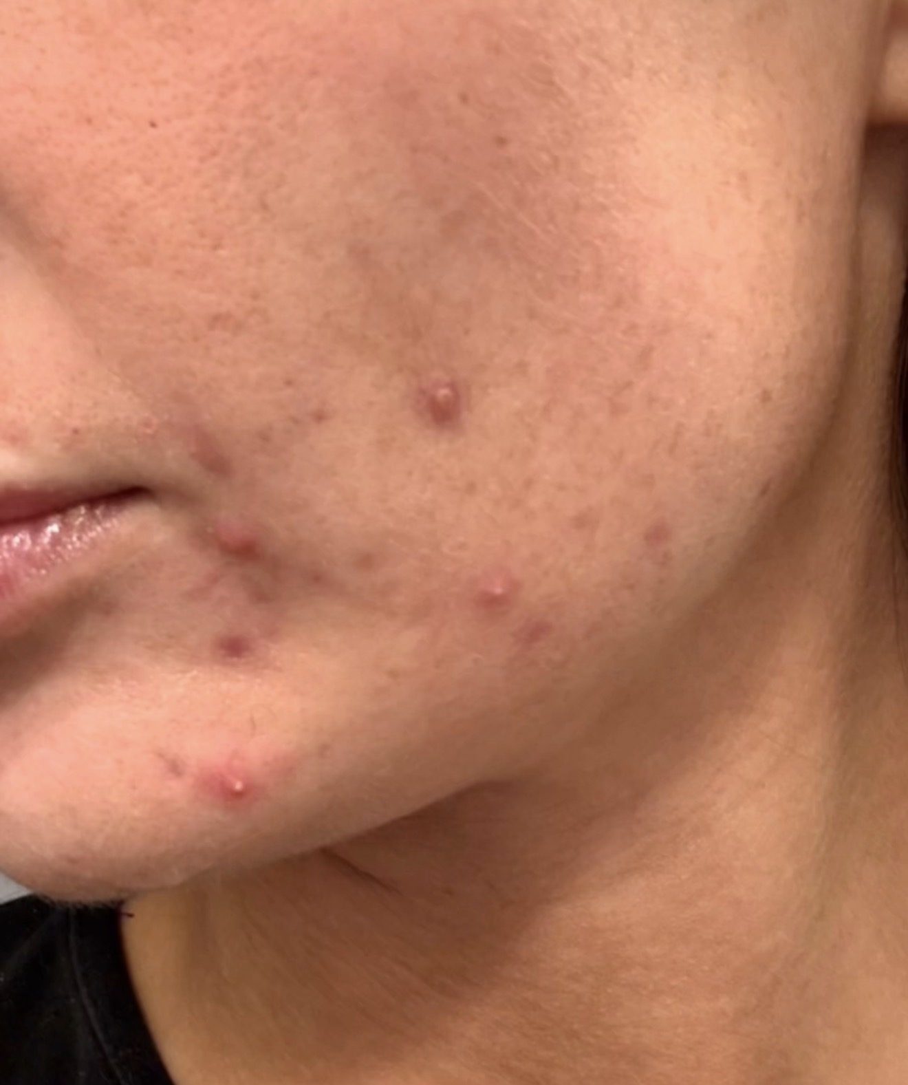 Close-up of acne-prone skin