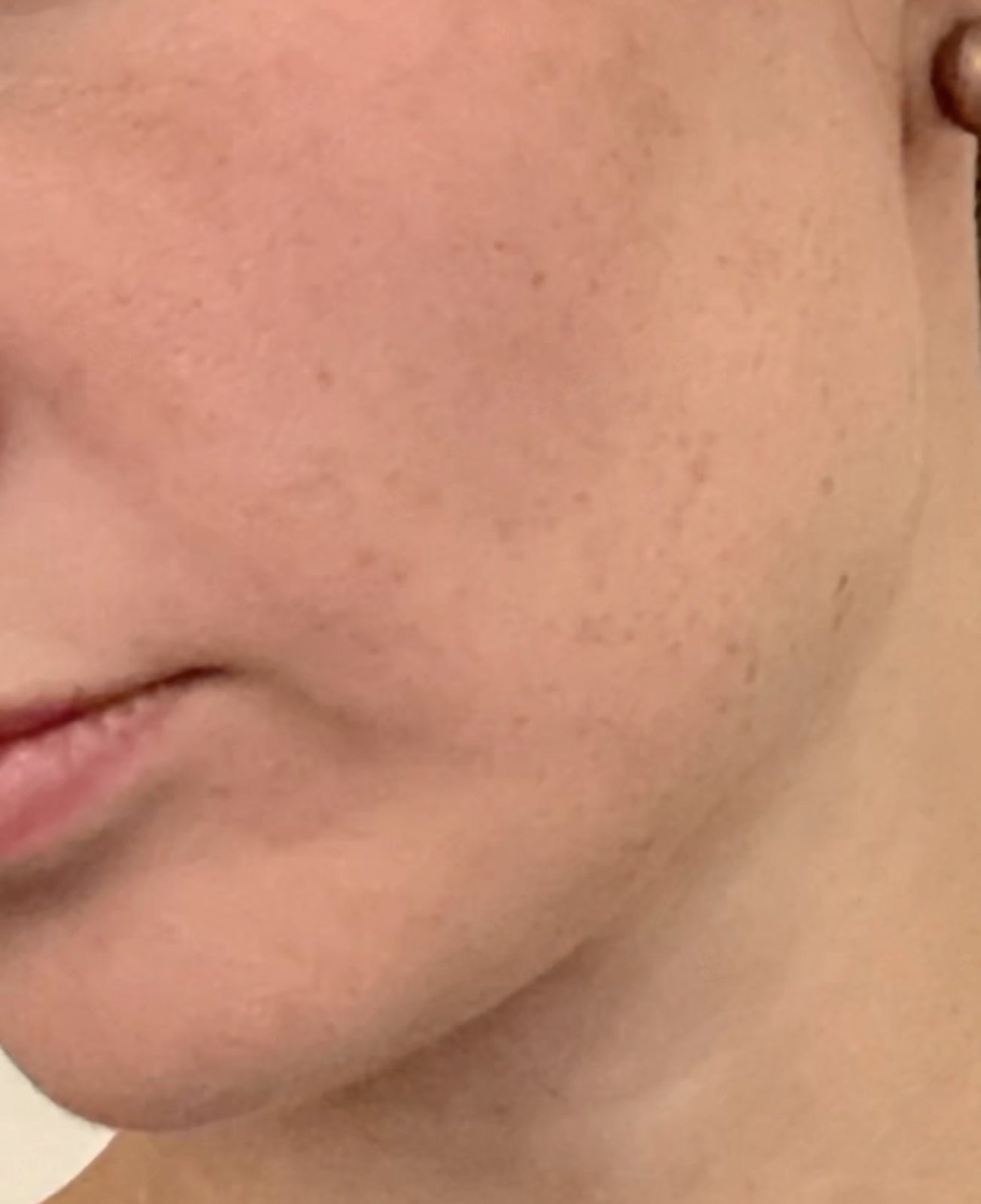 Skin after treatment