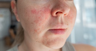 Close-up of peeling, irritated skin