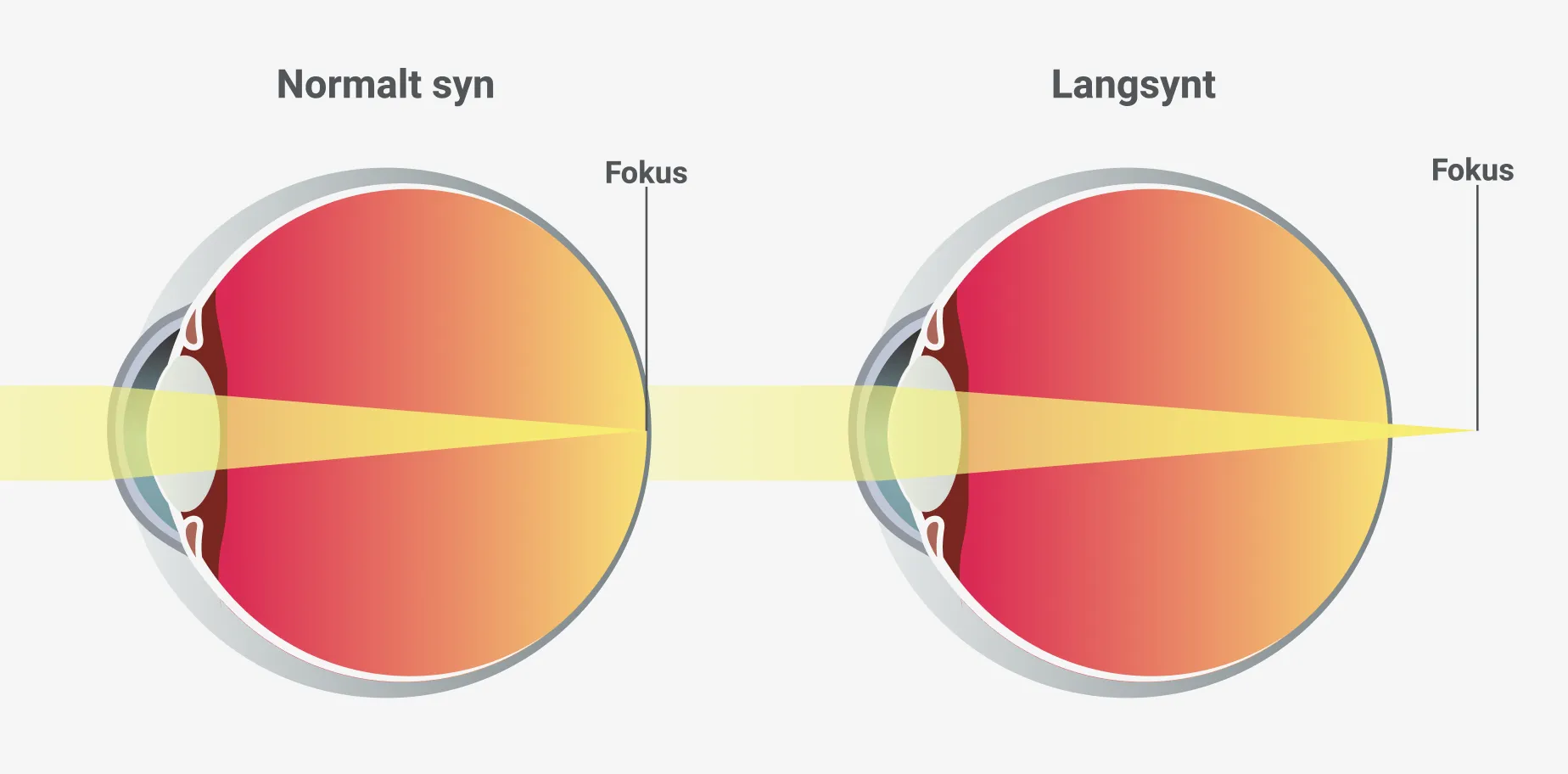 Illustrasjon av synsfeil på øyet når noen er langsynt.