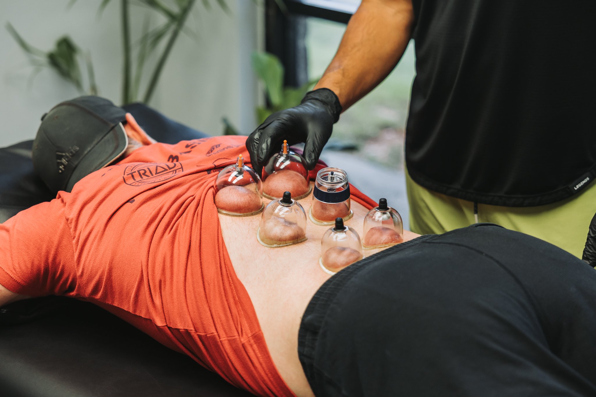 cupping physical therapy