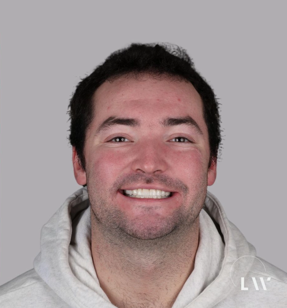 Full-mouth reconstruction result — patient treated at Livewell Dental, Fairfax Station, VA