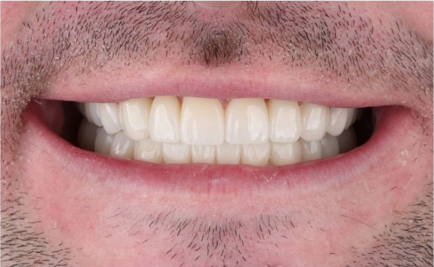 After smile makeover with porcelain veneers at Livewell Dental, Fairfax Station, VA