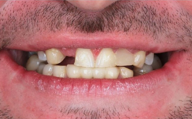 Before smile makeover: patient with stained and misaligned teeth