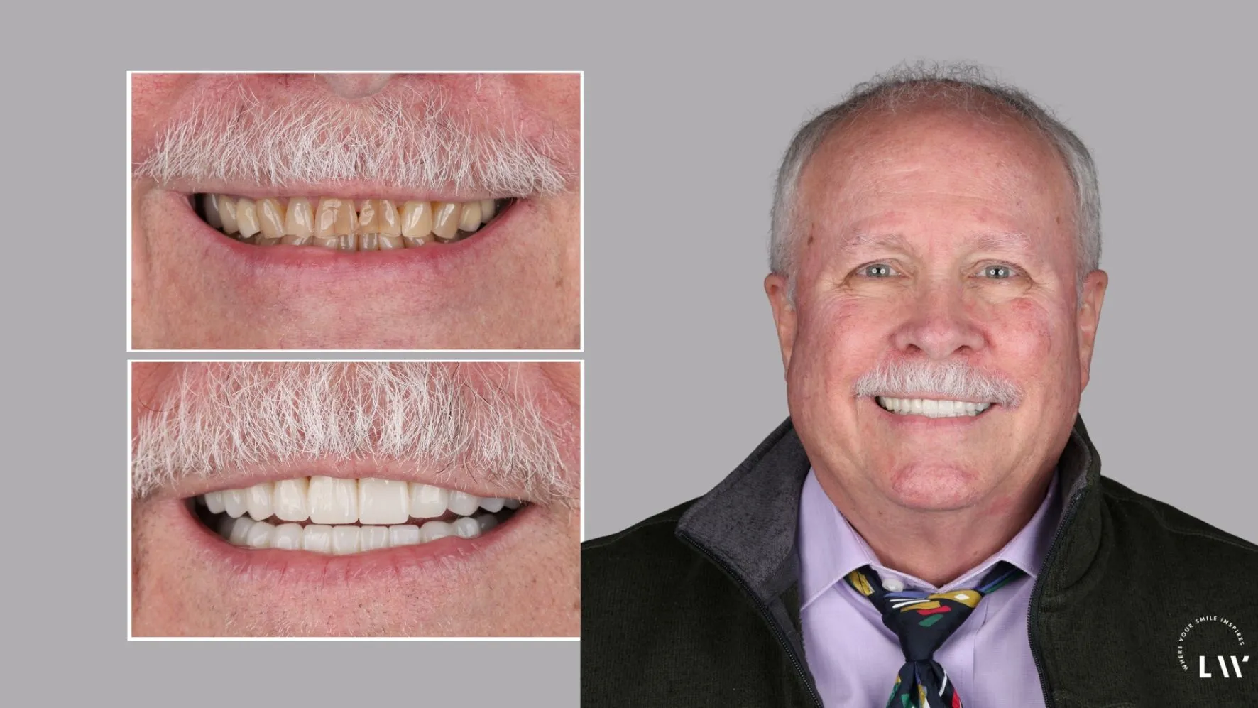 Before and after smile makeover result at Livewell Dental