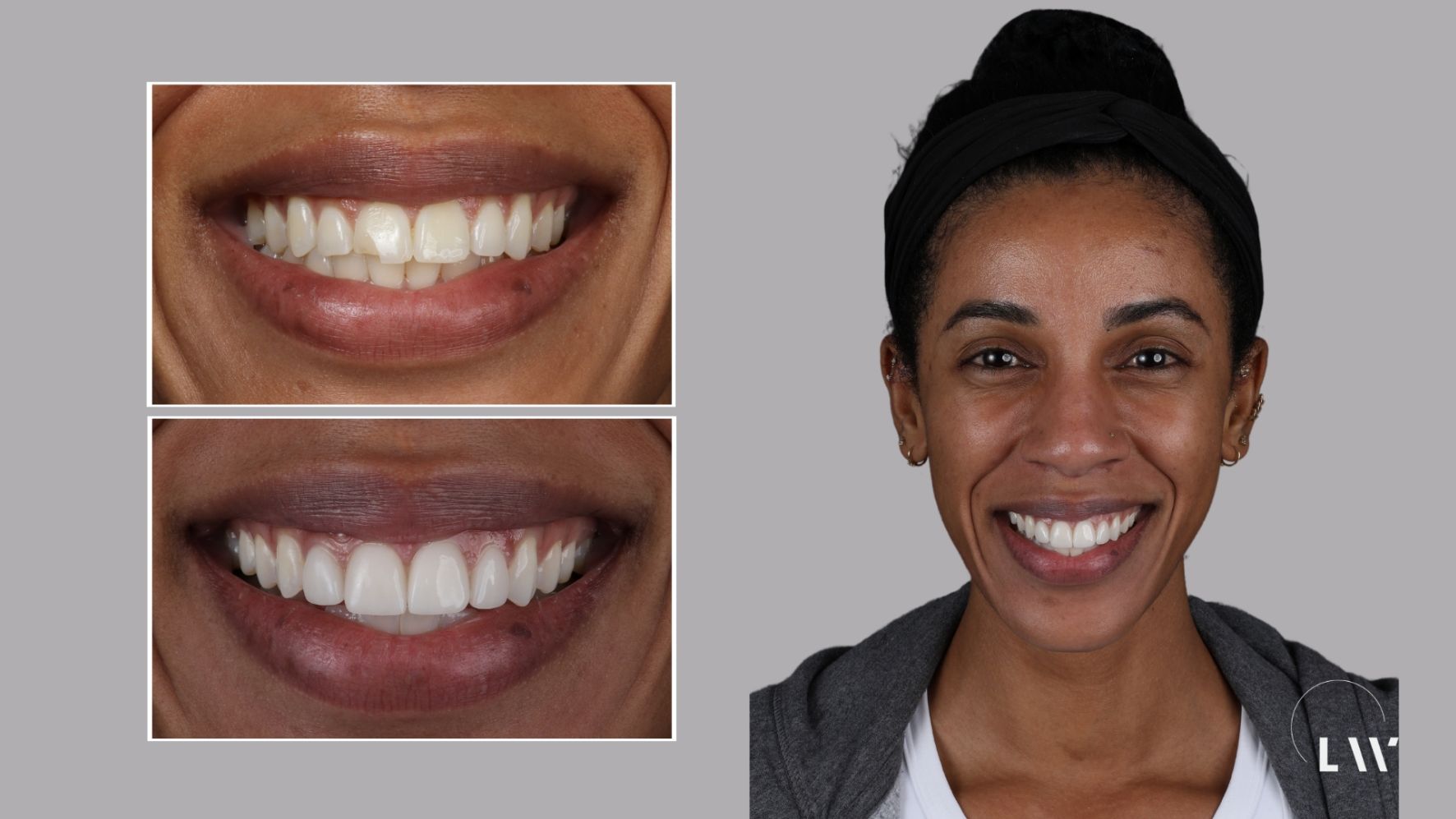 Before and after dental treatment at Livewell Dental, Fairfax Station, VA