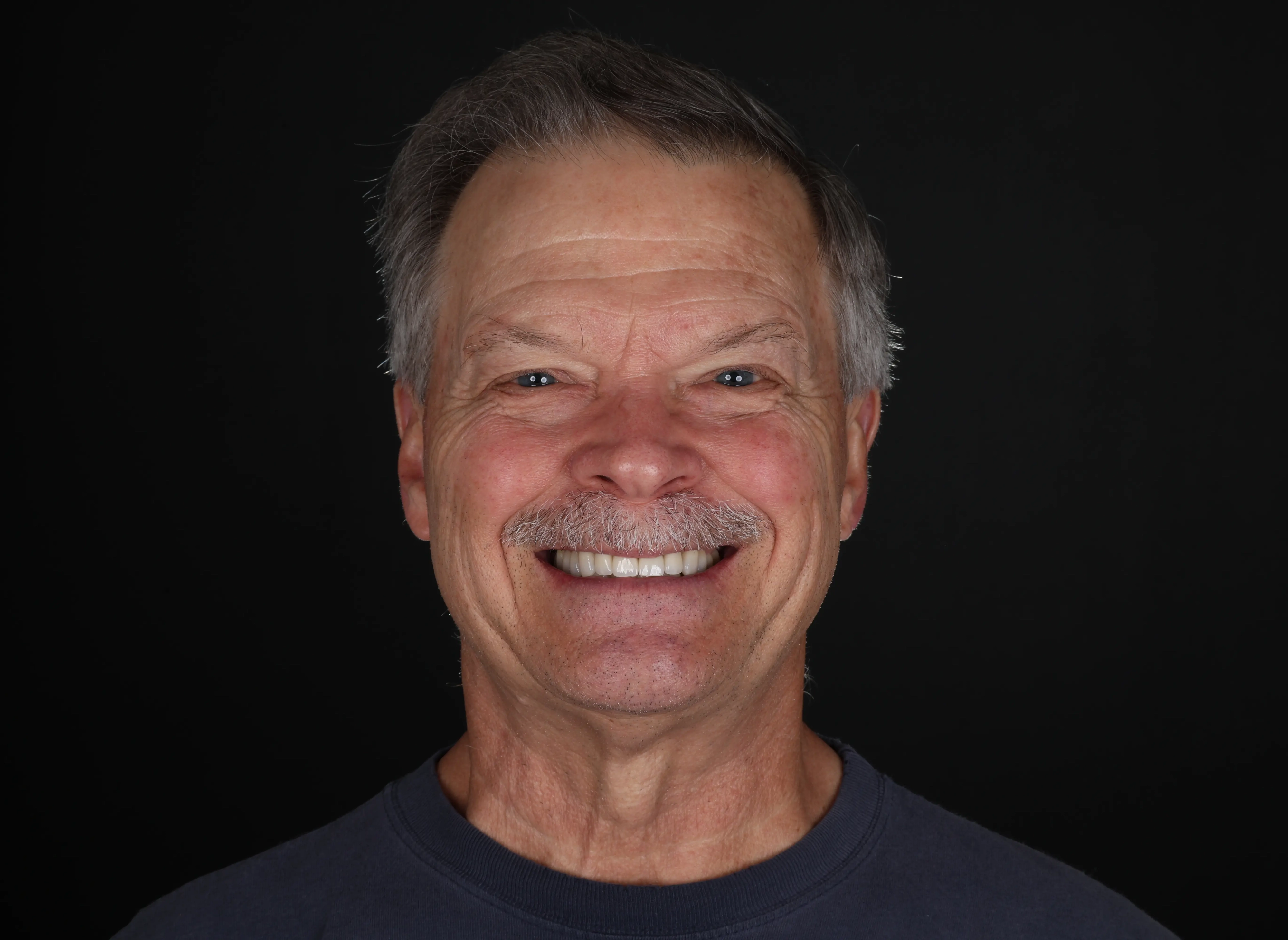 After smile makeover with porcelain veneers and gum recontouring at Livewell Dental
