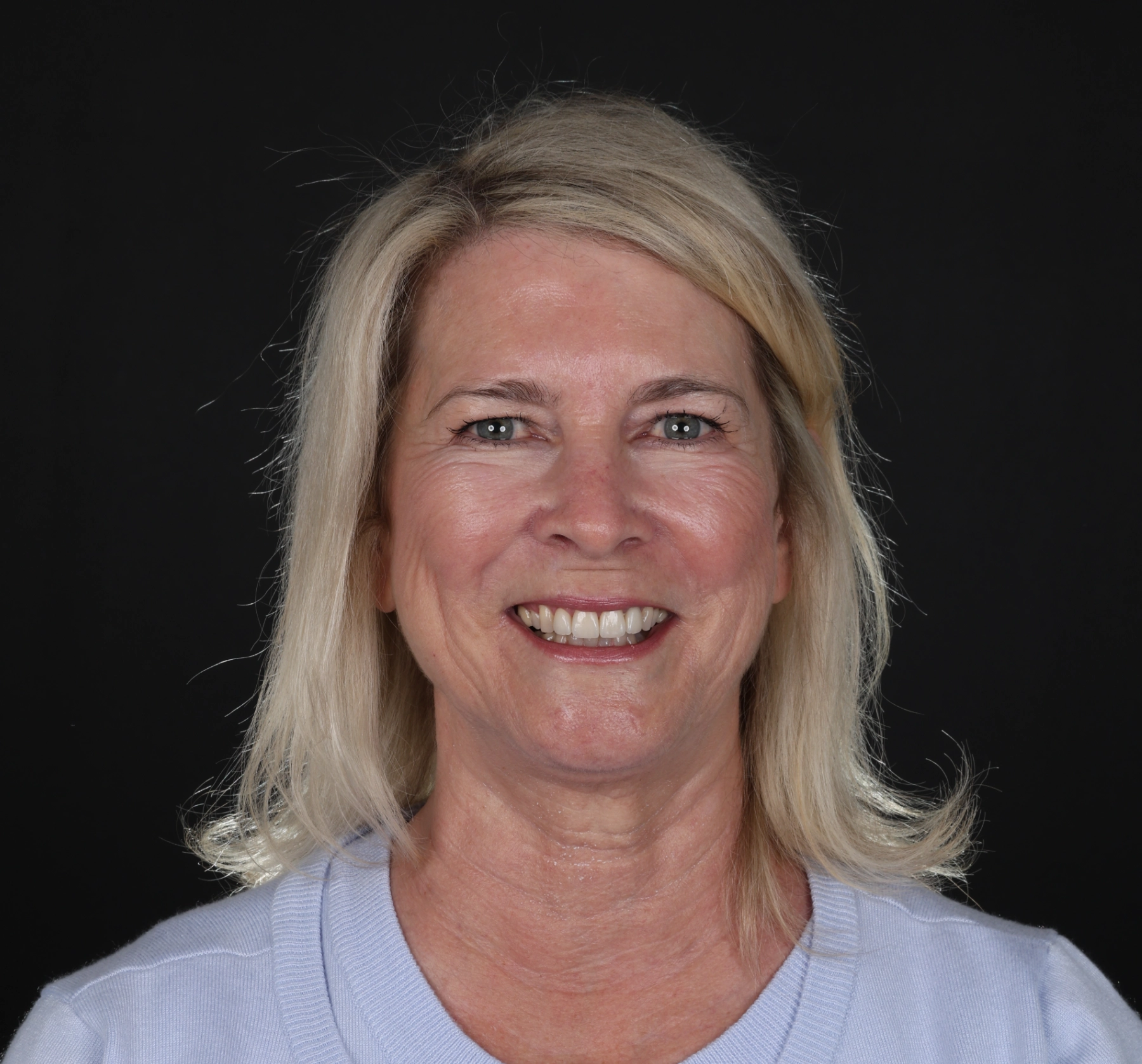 after full-mouth reconstruction result at Livewell Dental, Fairfax Station, VA