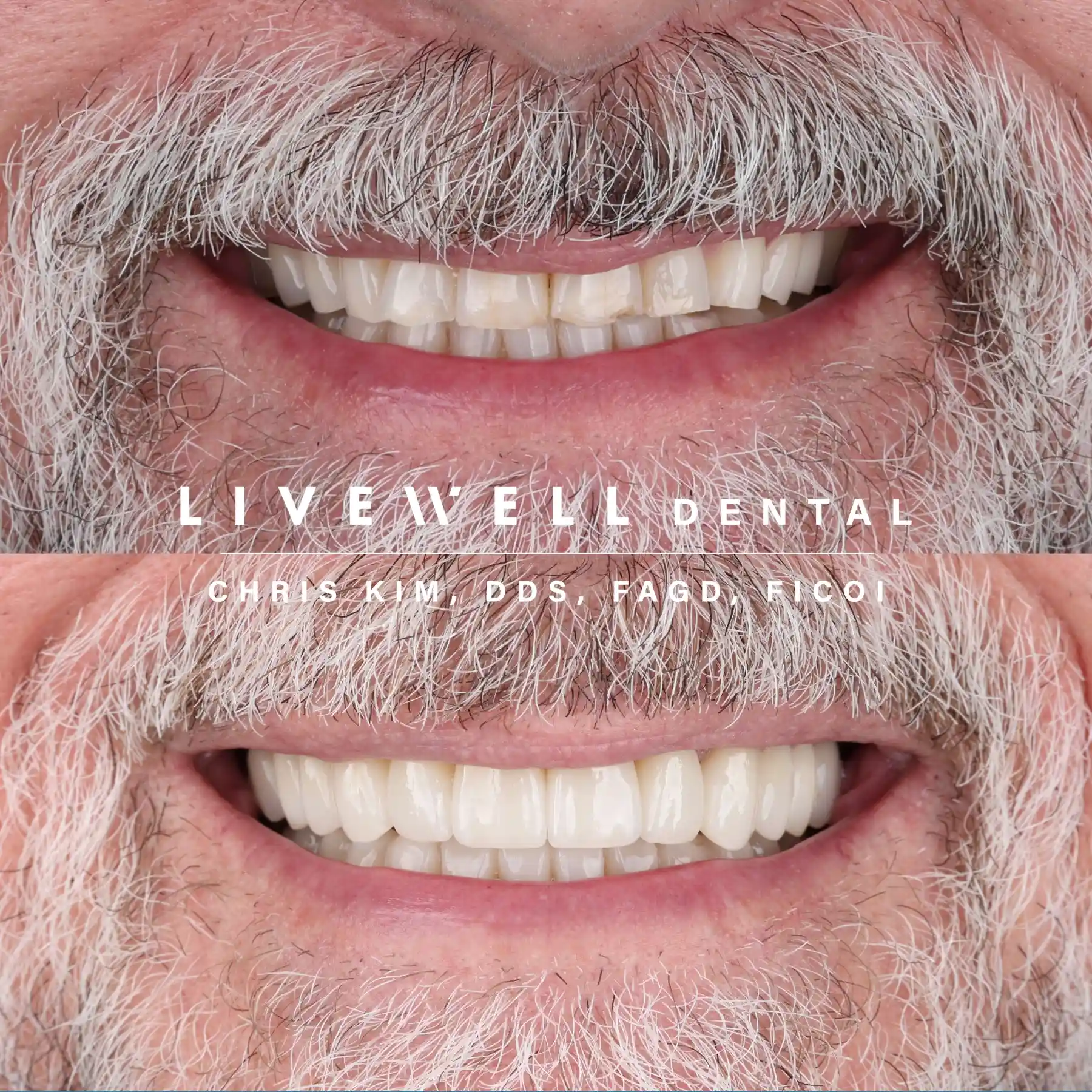 Ten upper teeth, harmonized to perfection. Balanced, bright, and confident — ready for any setting, any angle, any moment.
