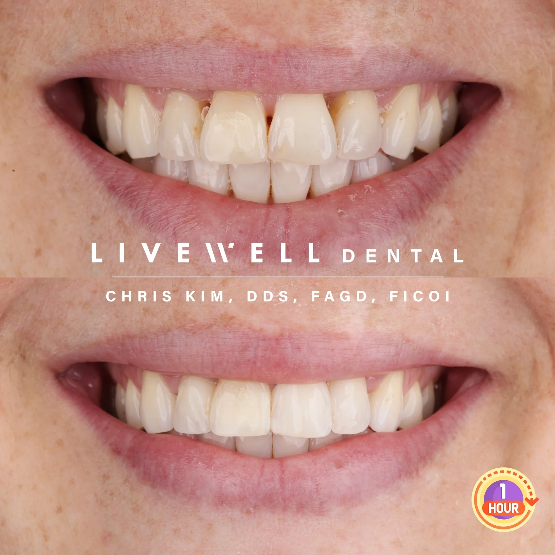 One tooth. Perfectly matched. A single restoration (veneer, crown, or bonding) crafted to vanish into your natural smile with microscopic precision.