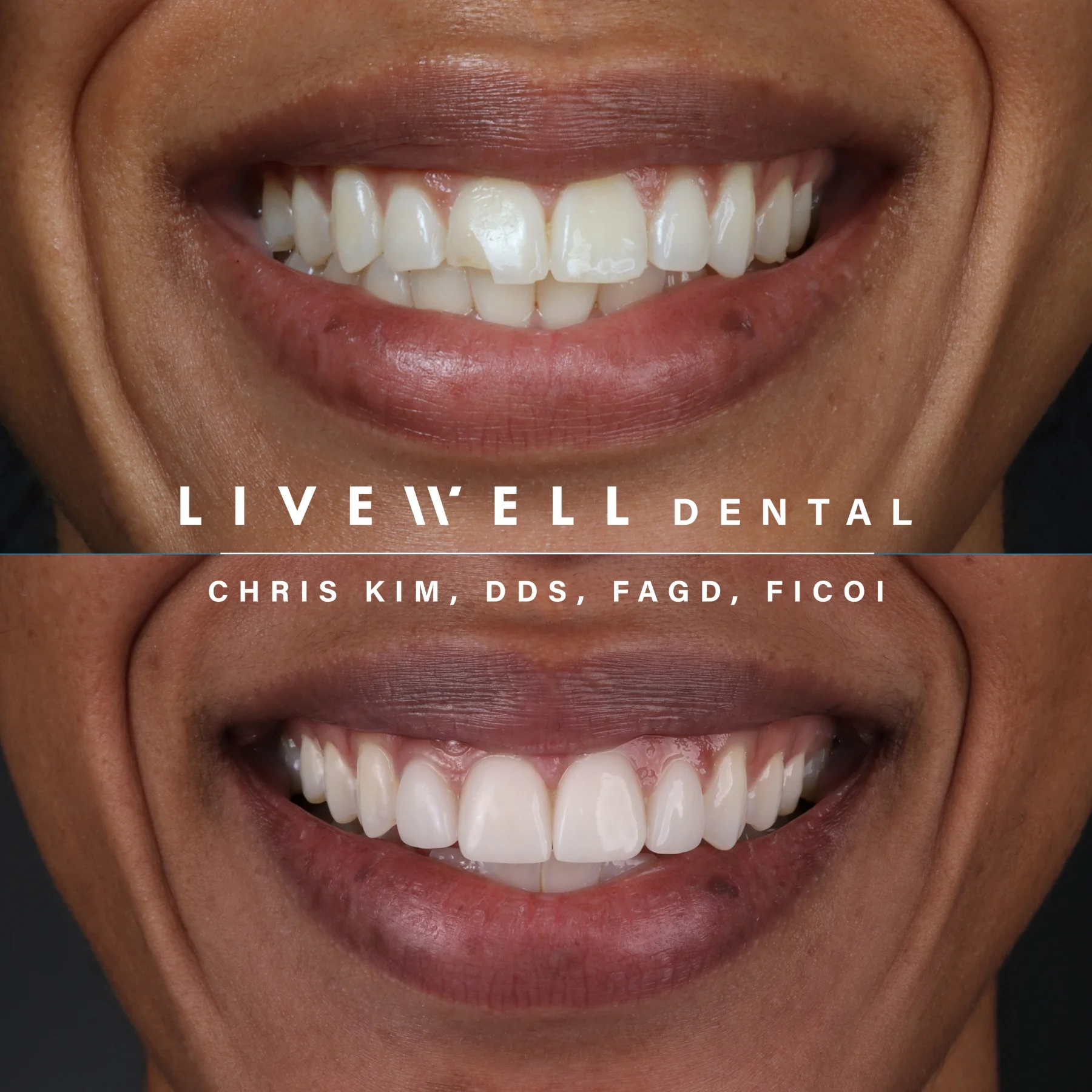 Four front teeth. One magical transformation. Ideal for fixing wear, discoloration, or imbalance in the most visible zone of your smile.