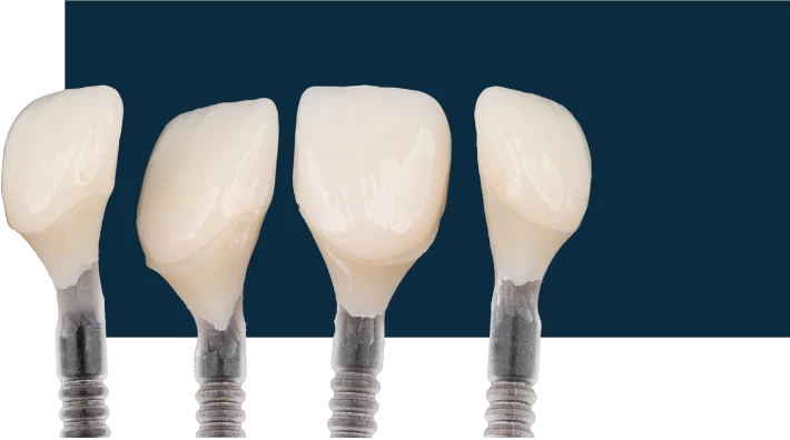 Four porcelain veneer samples showing shape, translucency, and surface texture
