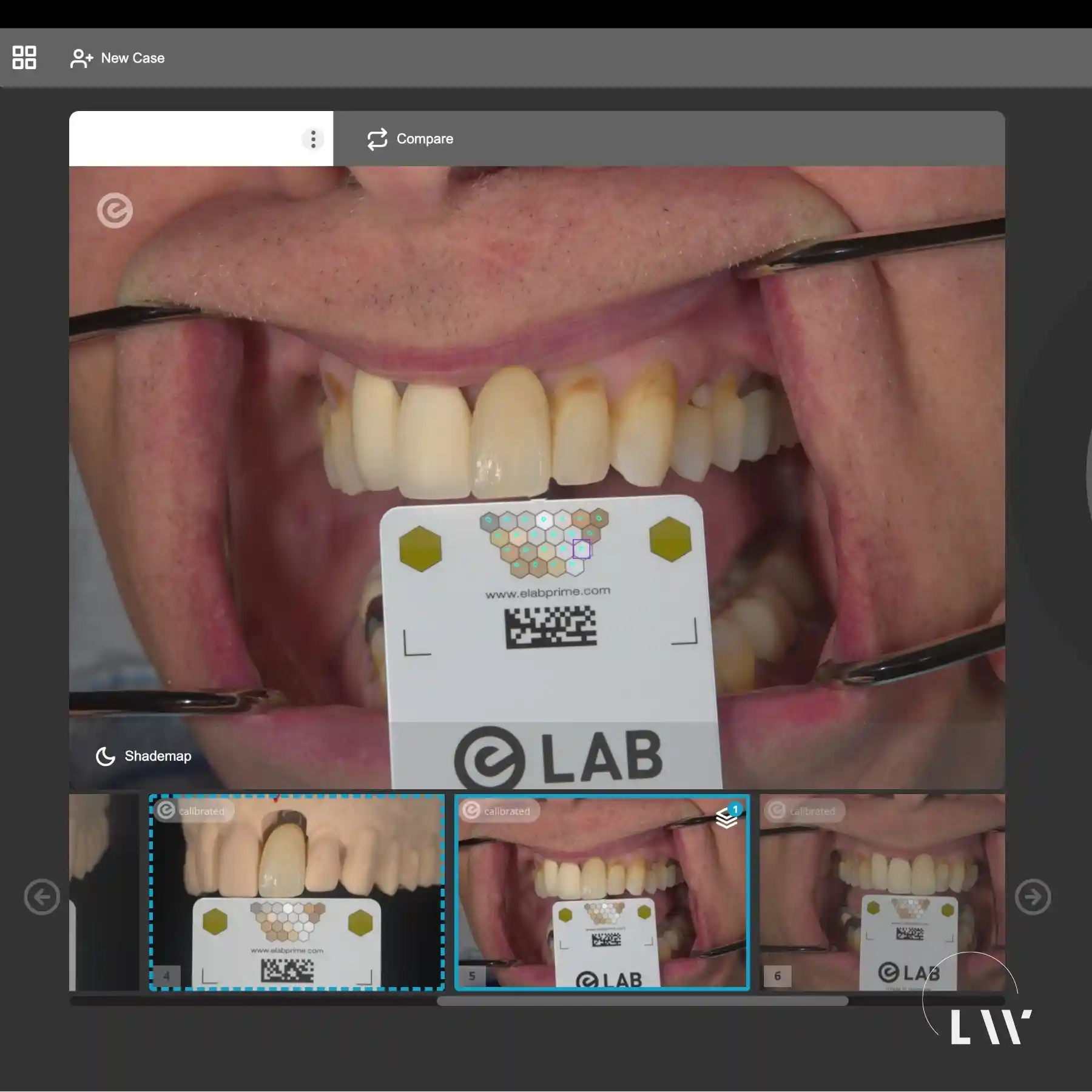 eLab digital veneer design before and after