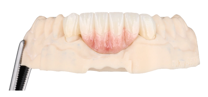Dental bridge