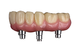 All-on-X implant restoration example