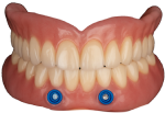 Locator-retained denture implant example