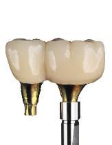 Implant bridge example for multiple missing teeth