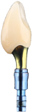 Single dental implant