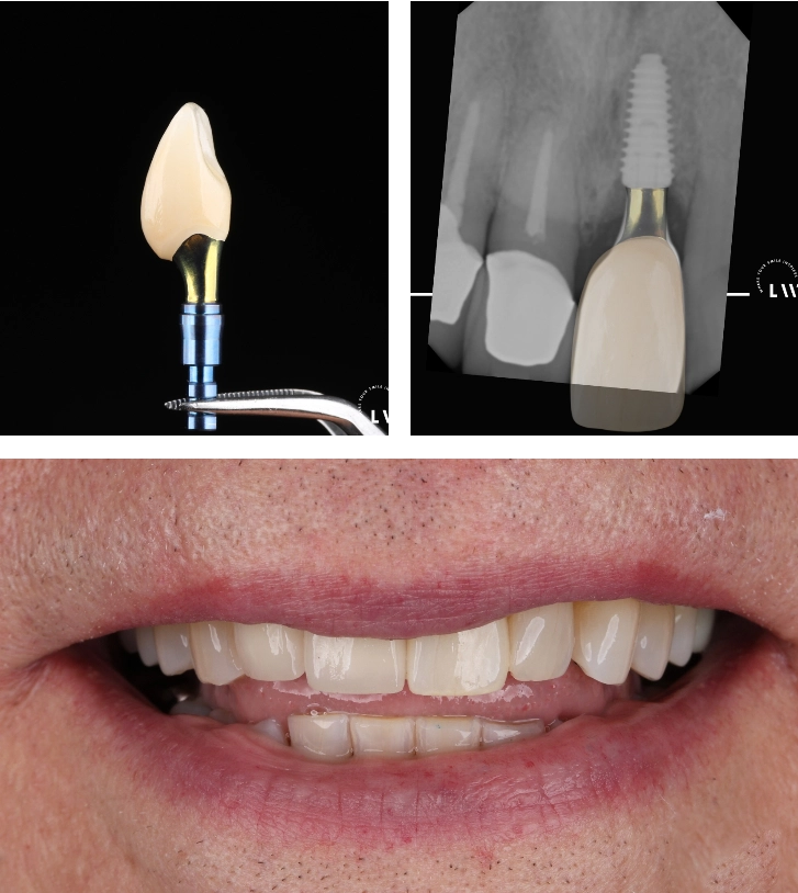 Dental implant patient story at Livewell Dental