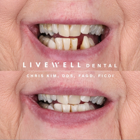 Dental bridge before and after result at Livewell Dental