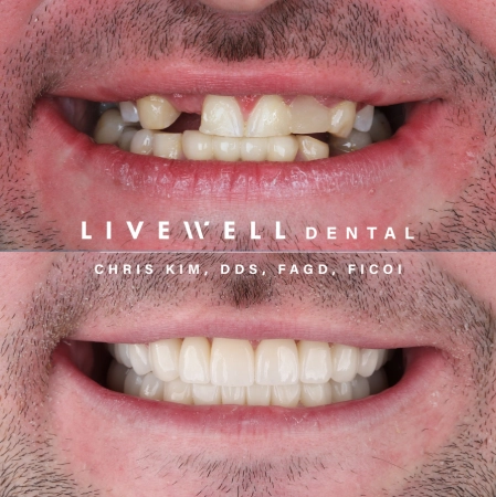Dental bridge restoration before and after at Livewell Dental