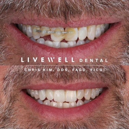 Dental bridge case result by Dr. Chris Kim at Livewell Dental