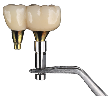 Implant-supported dental bridge diagram