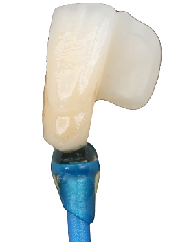 Maryland bonded dental bridge diagram