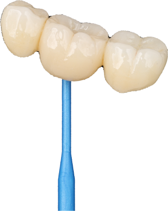 Tooth-supported dental bridge diagram