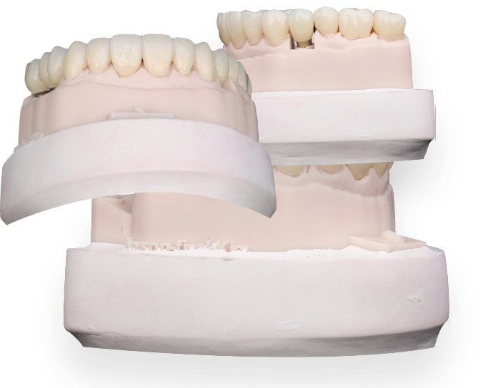 Dental model showing bite reconstruction planning at Livewell Dental