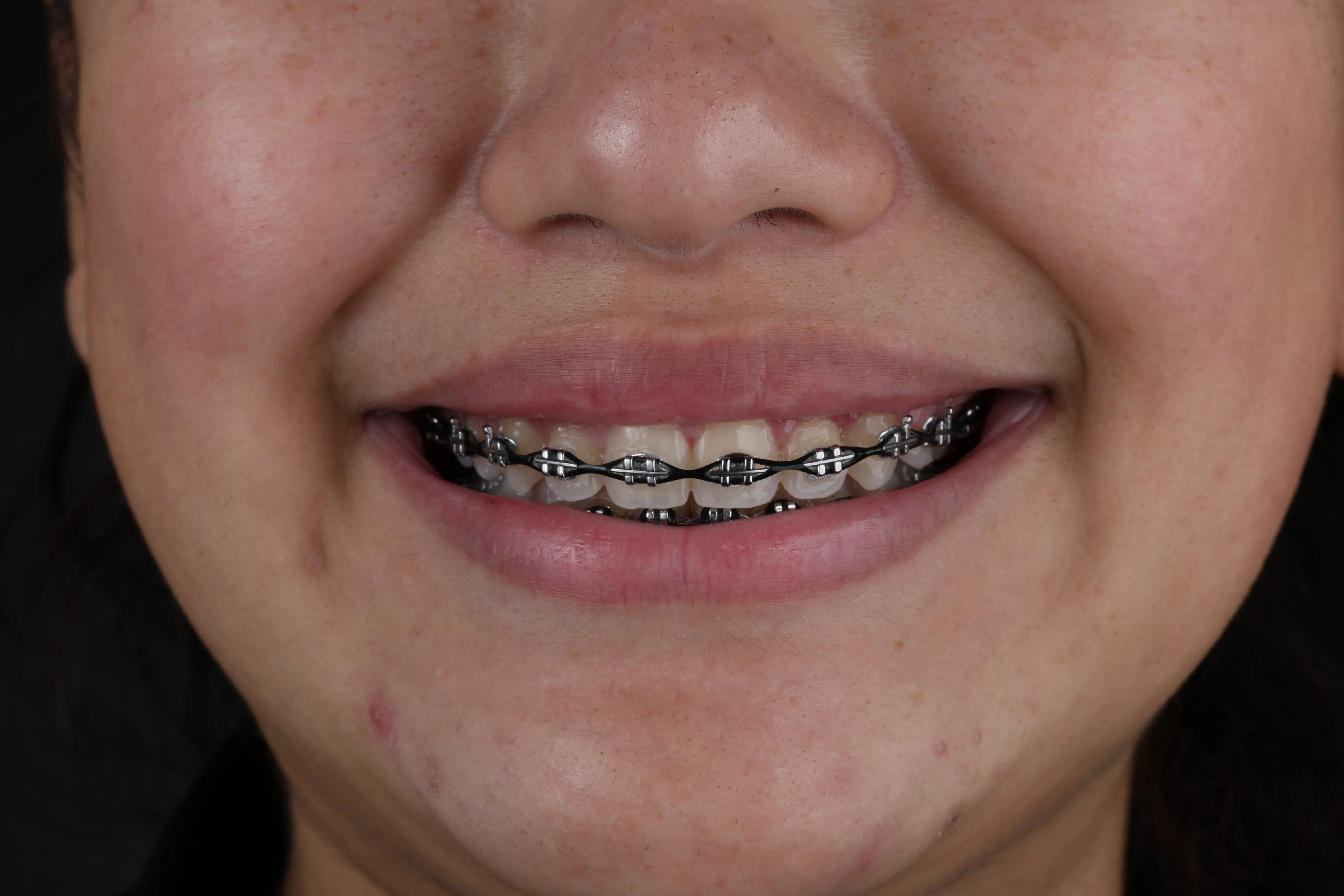 Dental braces orthodontic treatment at Livewell Dental