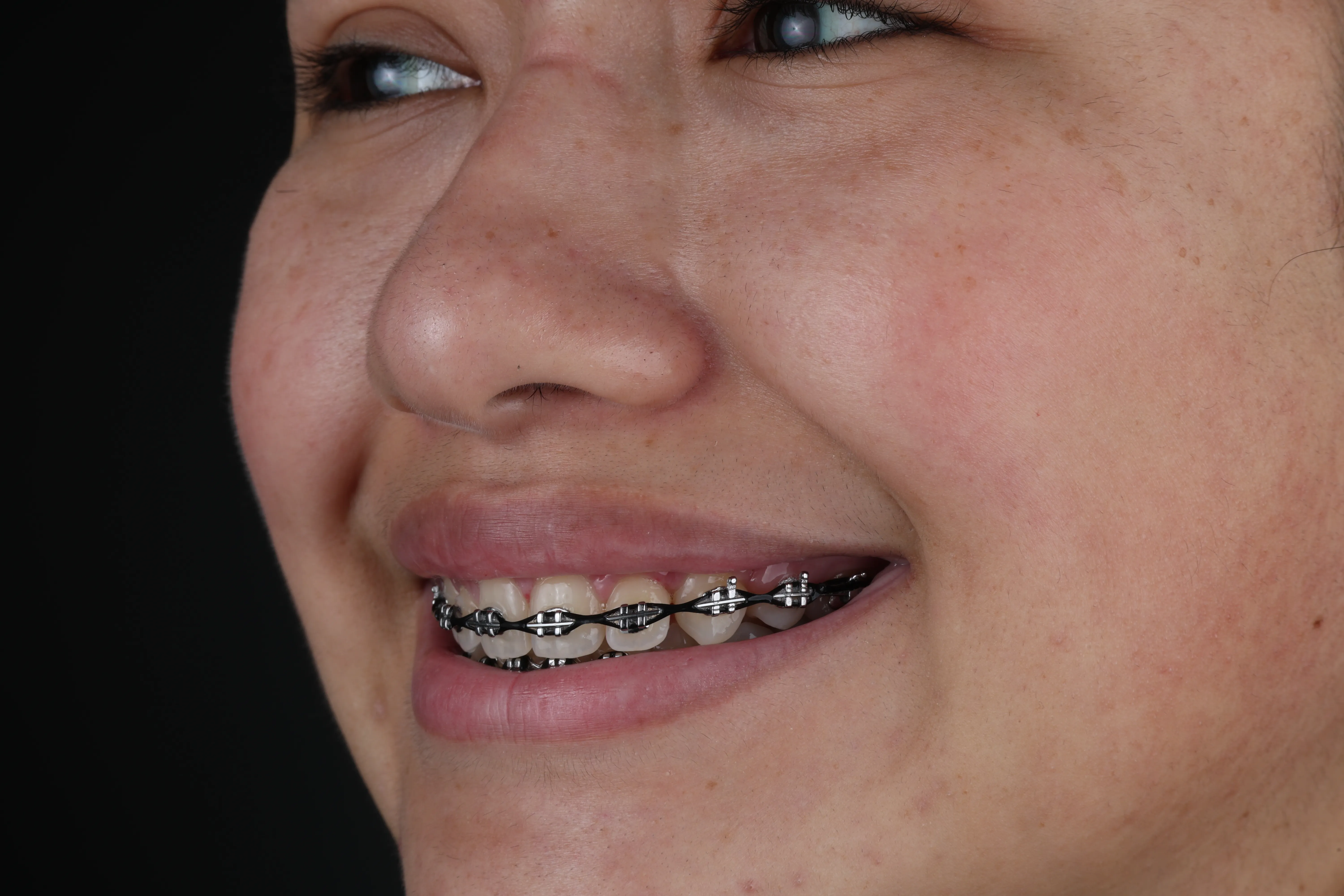 orthodontic treatment for crowded teeth at Livewell Dental