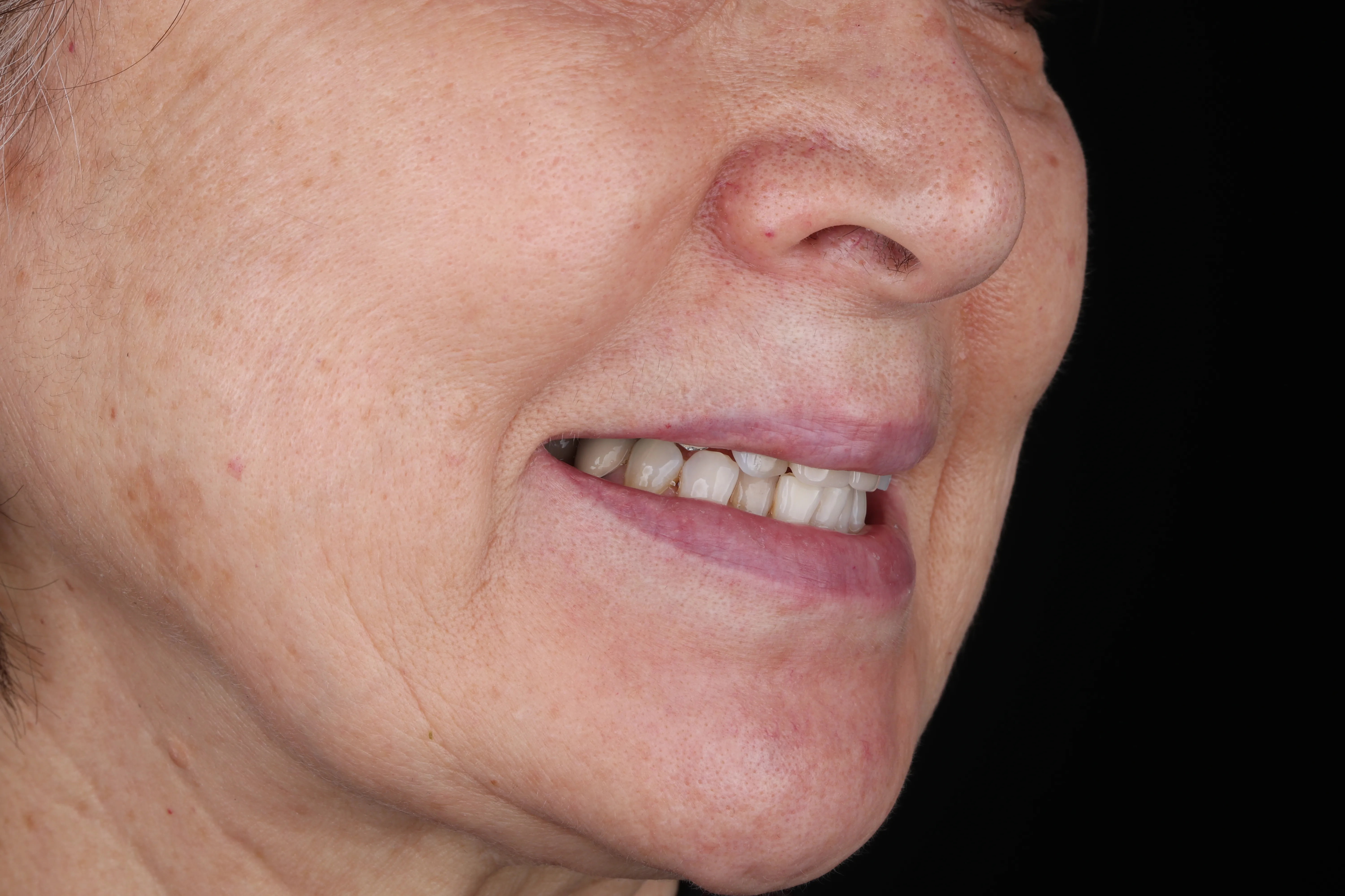 Before photo for full-arch implant treatment at Livewell Dental