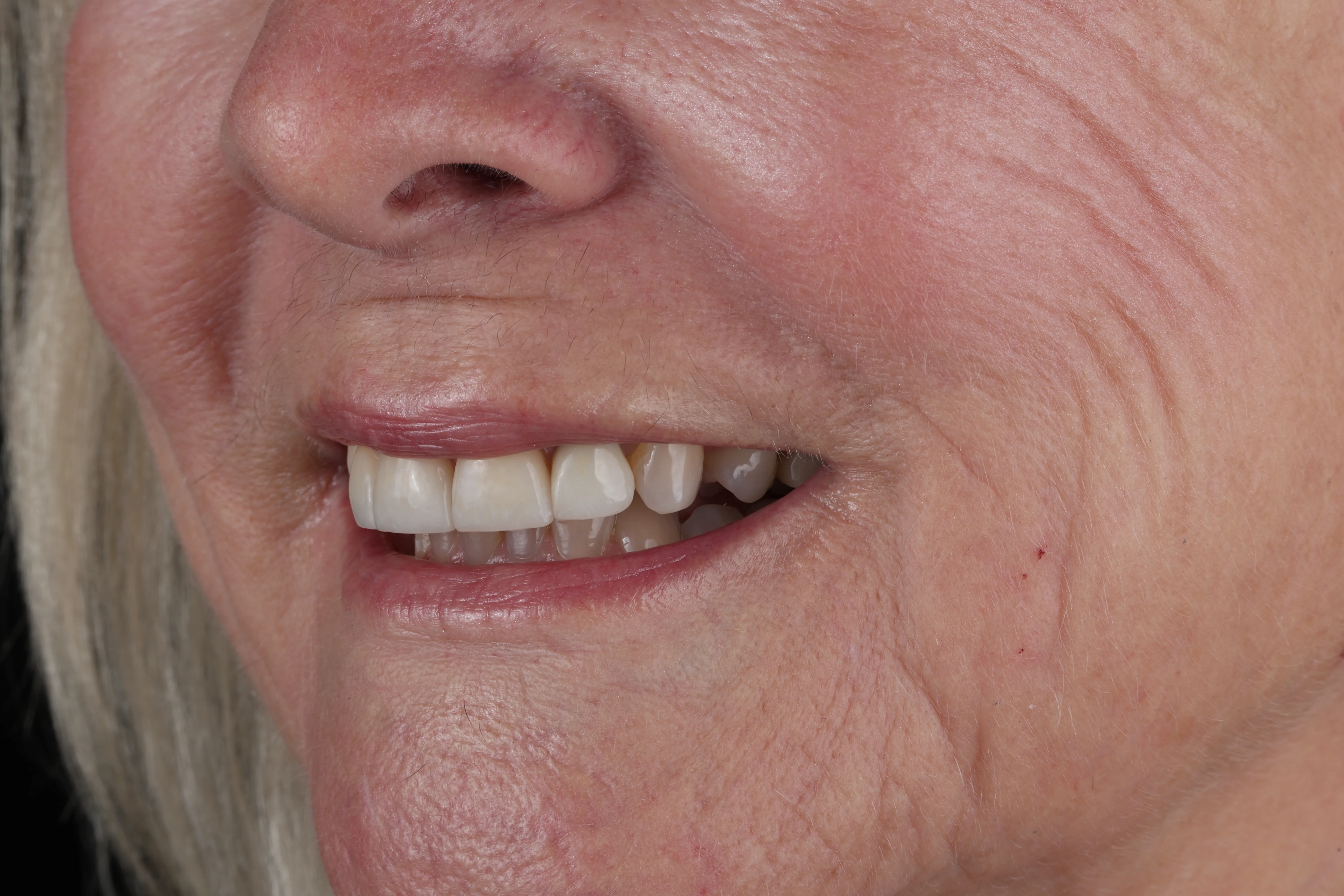 Before photo showing tooth damage before dental crown treatment at Livewell Dental