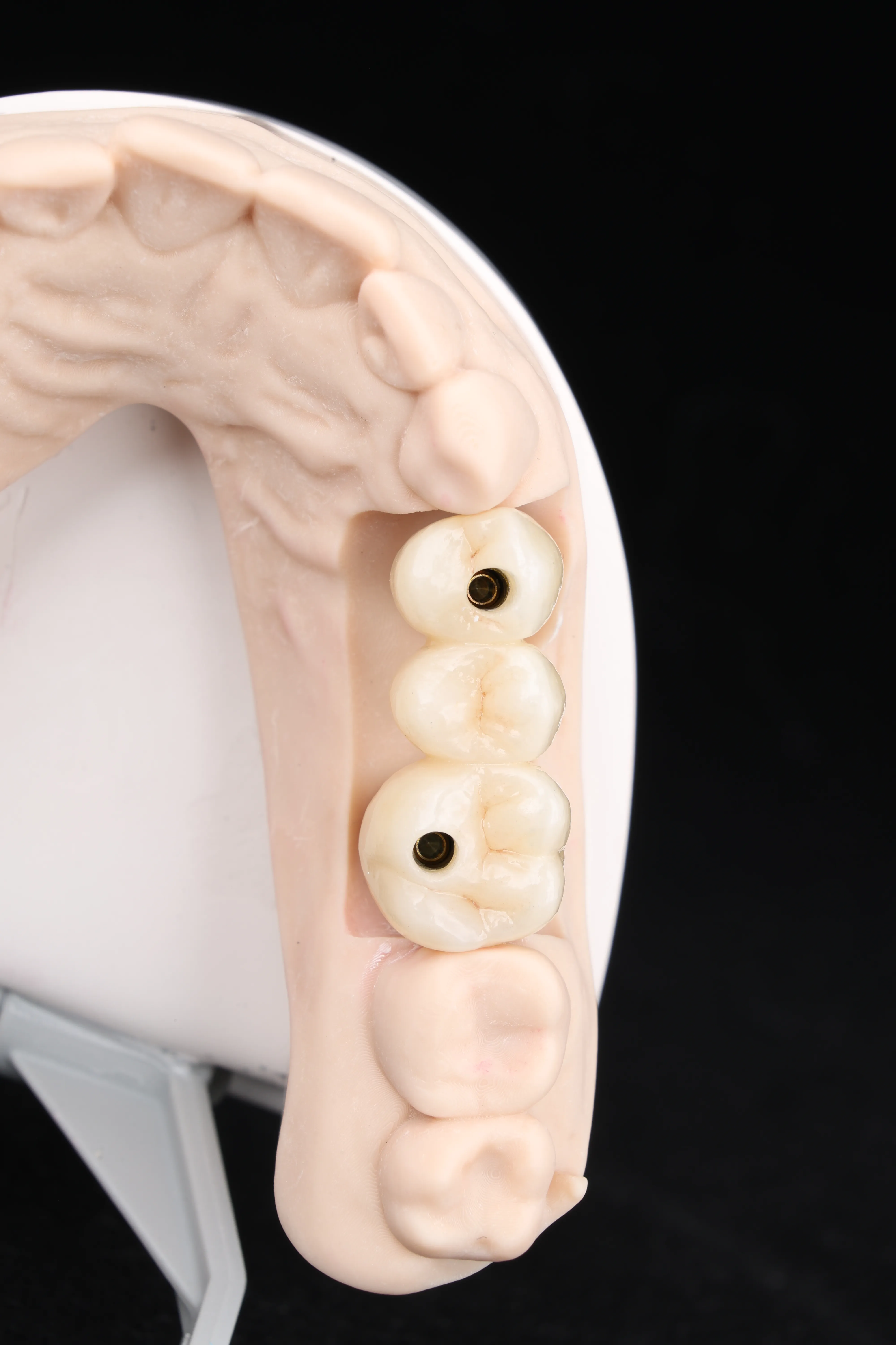 Implant bridge smile result at Livewell Dental in Fairfax Station, VA