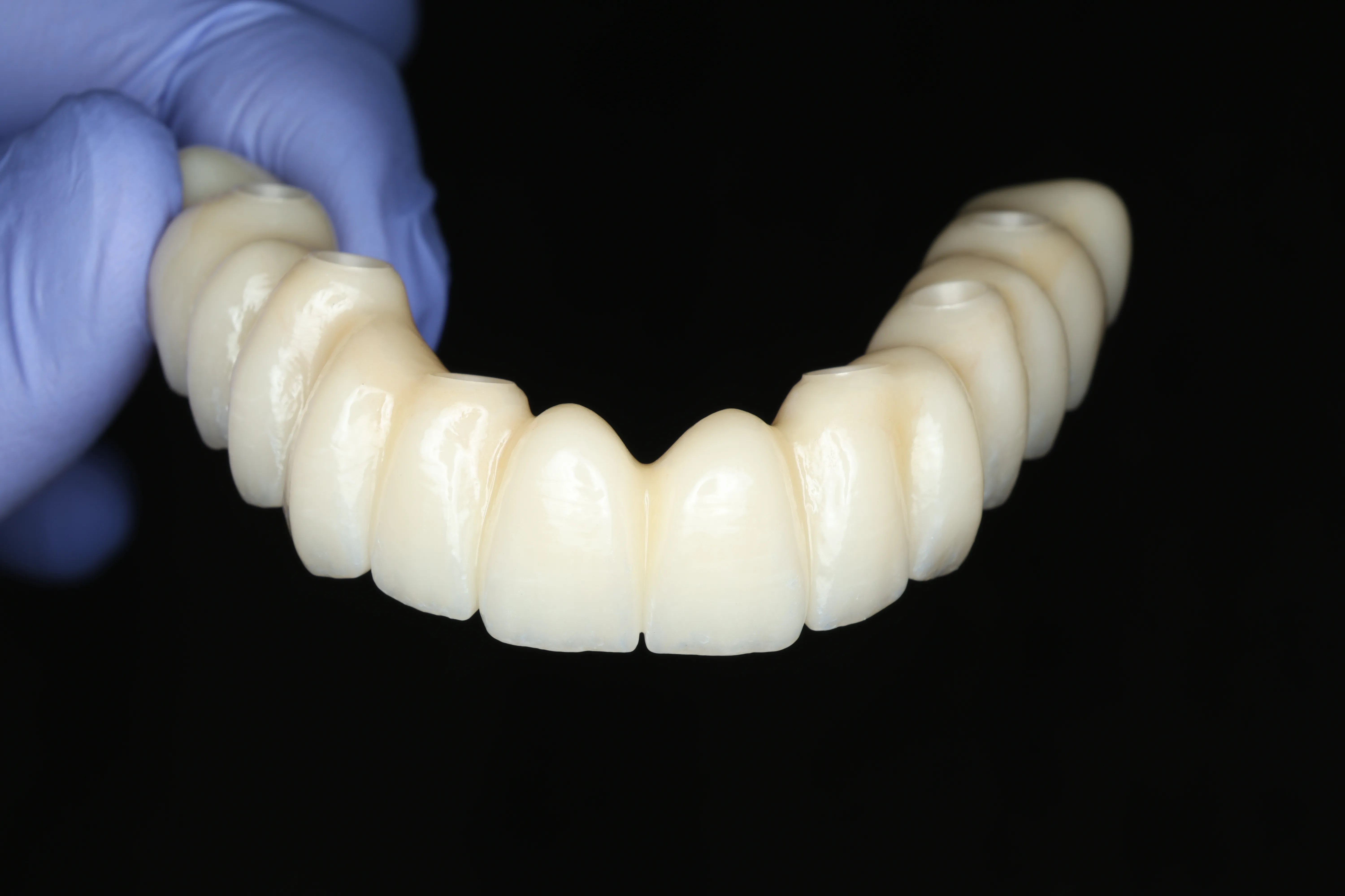 All-on-X implant planning and treatment at Livewell Dental
