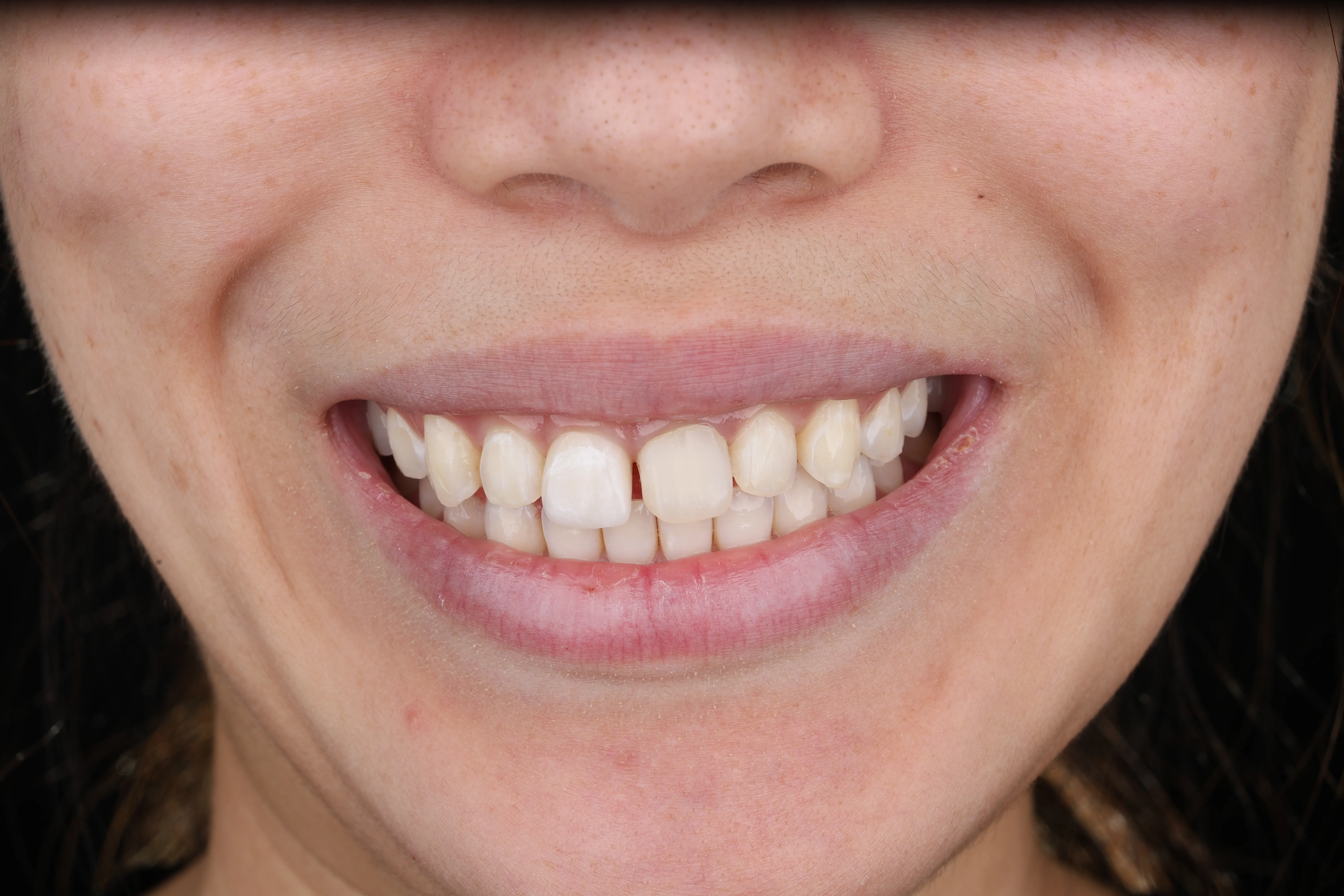 Before orthodontic treatment at Livewell Dental