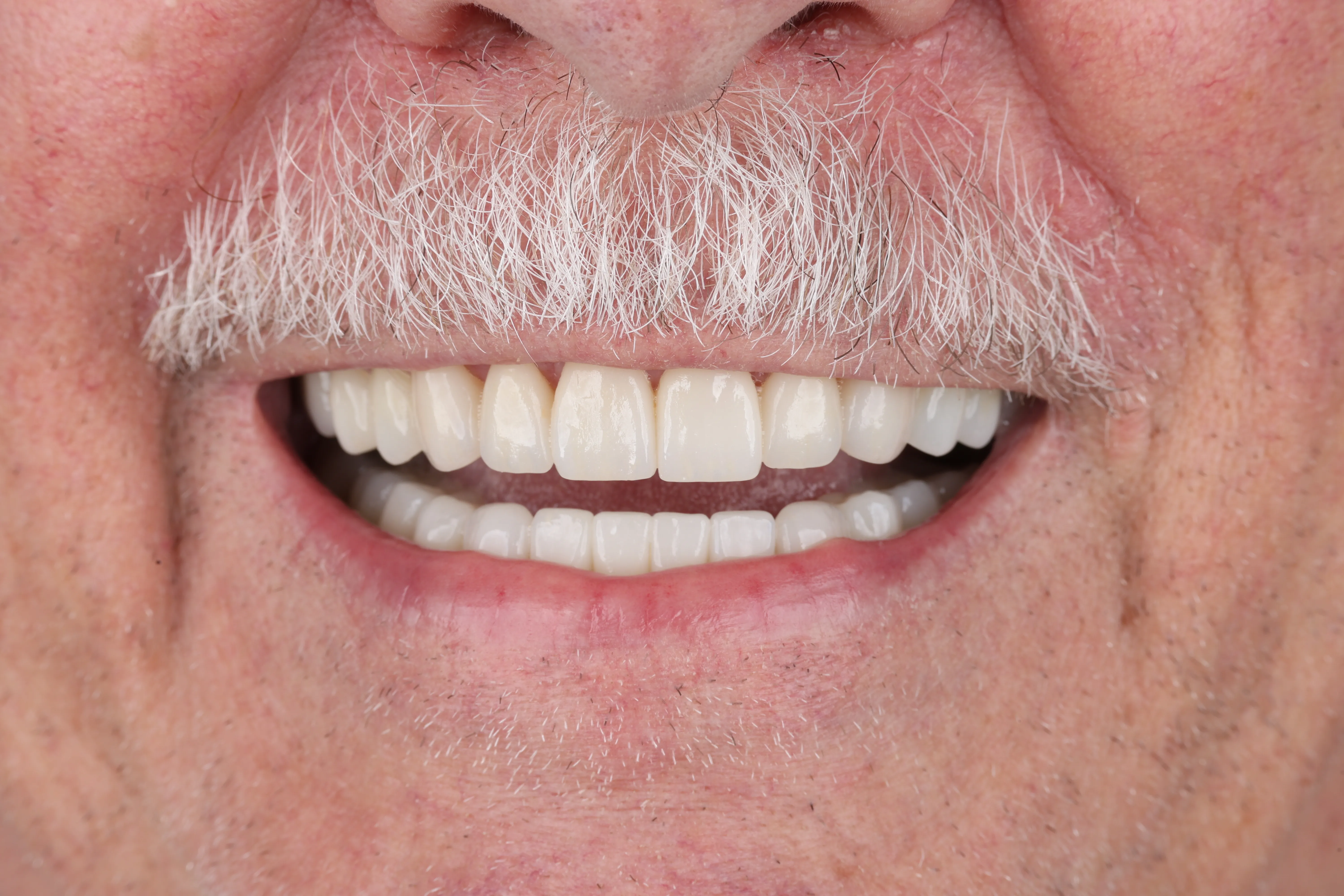 Smile result after full-mouth implant and restorative treatment at Livewell Dental