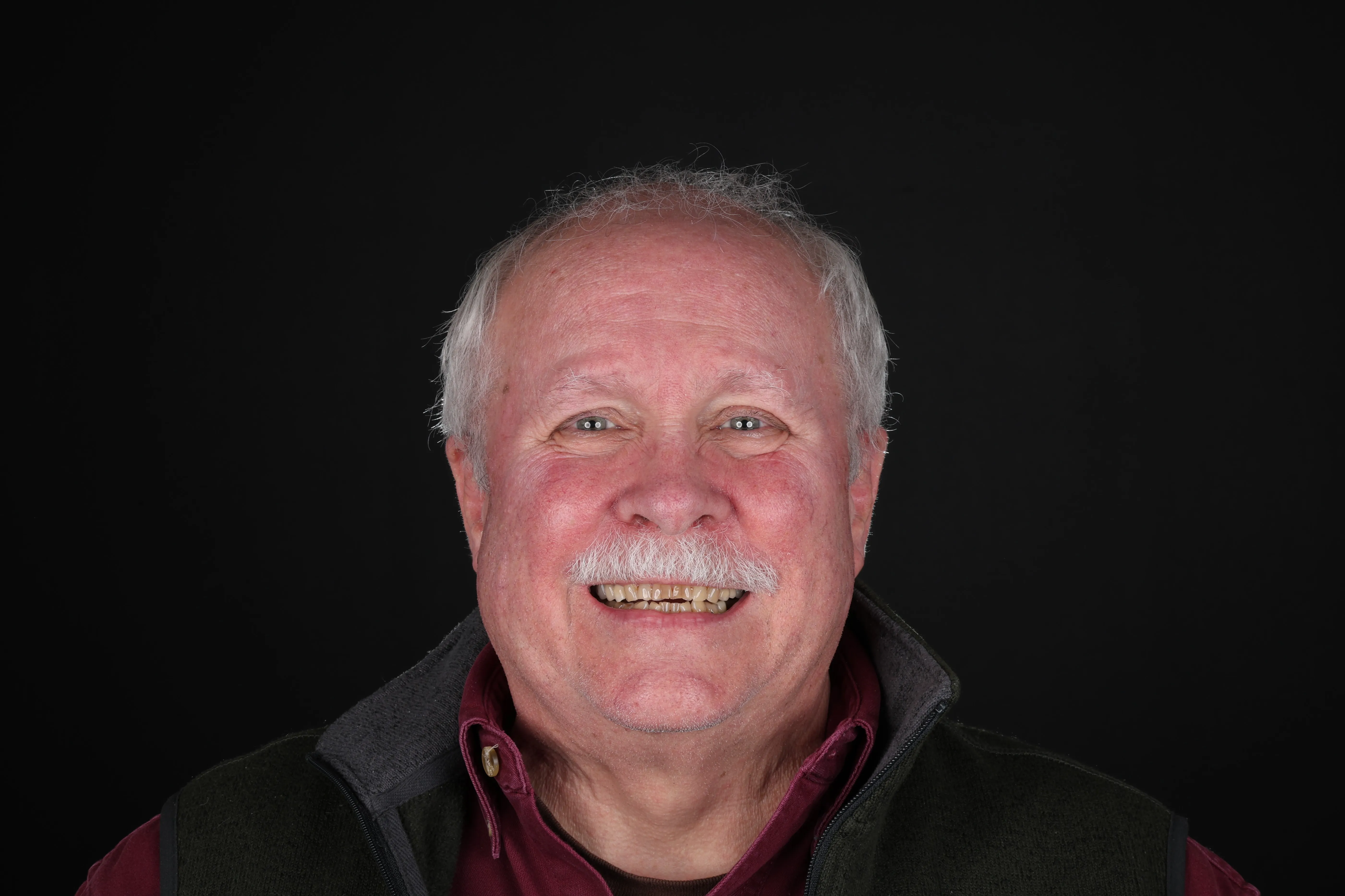 Before photo: patient with worn teeth, discoloration, and bite issues before treatment at Livewell Dental