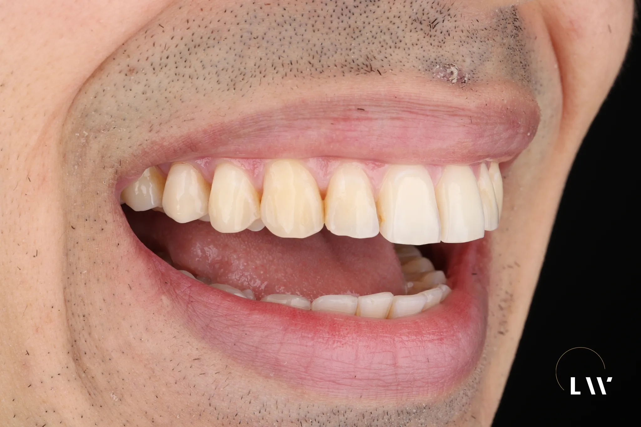 Dental restoration case result at Livewell Dental Fairfax Station